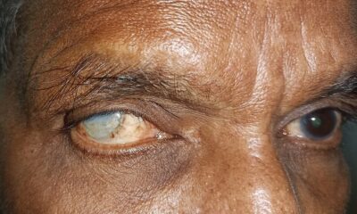 Corneal opacity right eye.jpg