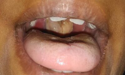 Diphtheria 3.jpeg