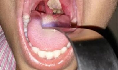 Diphtheria.jpg